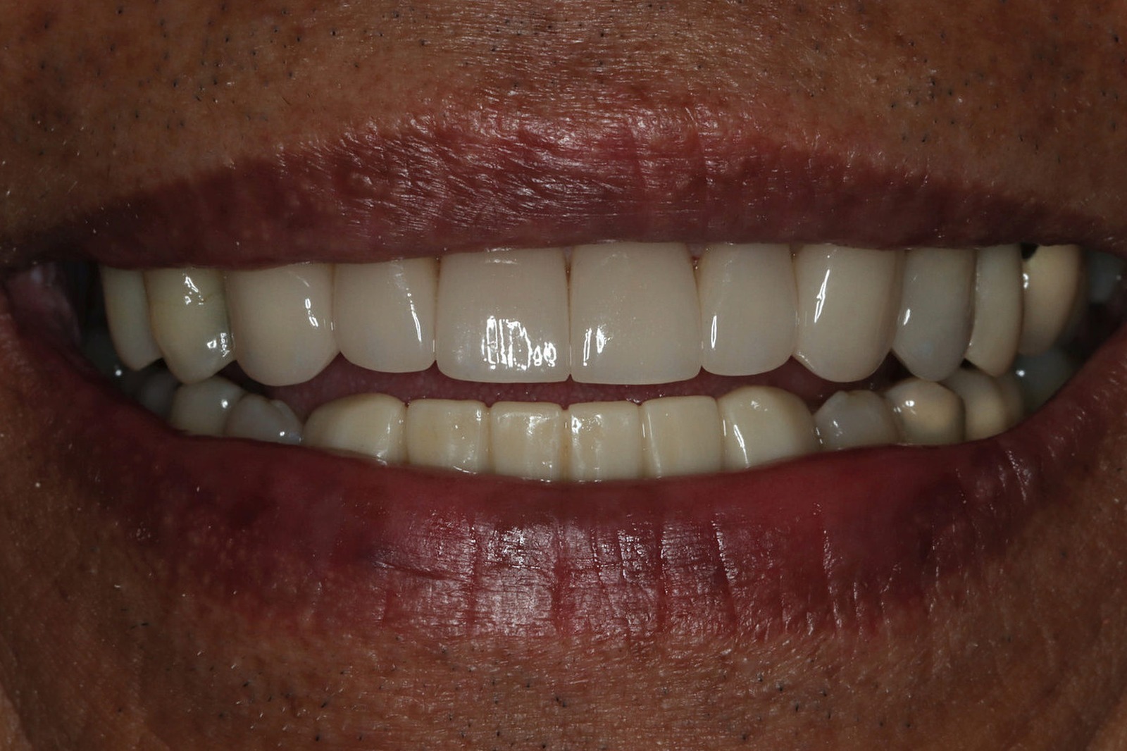 After treatment: an even, natural-looking restored upper smile on the same Bonin Dental Care patient