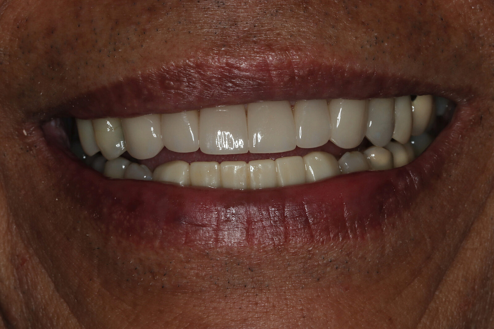After treatment: an even, natural-looking restored upper smile on the same Bonin Dental Care patient