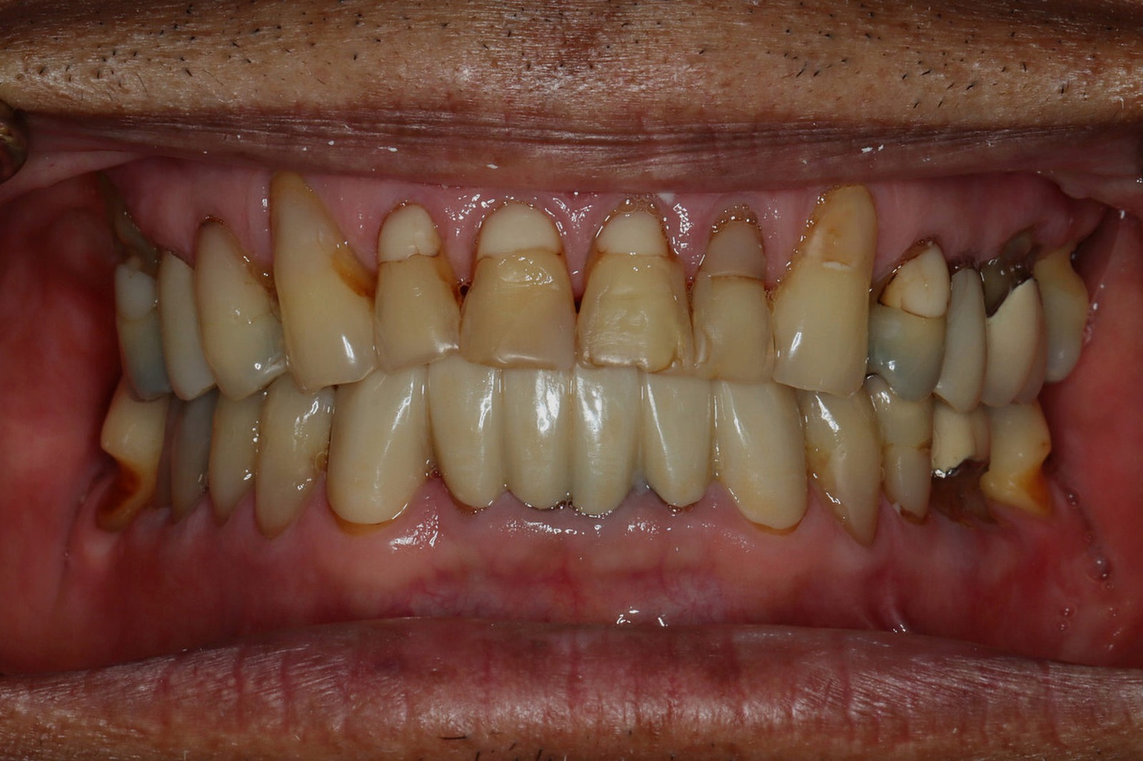Before treatment: worn, crowded, and discolored upper teeth on an actual Bonin Dental Care patient in Windsor, CA