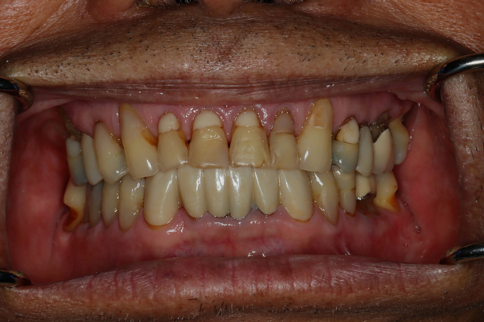 Before treatment: worn, crowded, and discolored upper teeth on an actual Bonin Dental Care patient in Windsor, CA